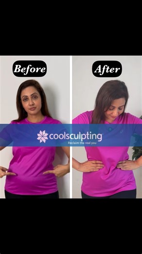 Hi friends, if you want to know more about Coolsculpting procedure, check out this video. For more info you can get in touch with @cutis.in Watch full video on my YOUTUBE. (Link in Bio) #garimasgoodlife #garimagoel #reels #reelsinstagram #fitness #coolsculpting #fatfreez #trend #explorepage✨ #explore #fypage #foryou #bodypositive #body | Garima Goel
