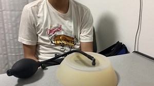 TESTIMONIO: El Vacuum Bell para curar el PECTUS EXCAVATUM (tórax hundido) sirve en cualquier edad, como en este caso exitoso en un adolescente. | Pectus Perú