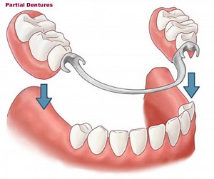 FAQs About Partial Dentures