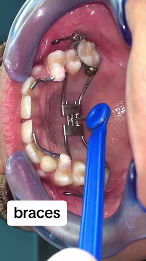Understanding Palatal Expanders in Dental Treatment