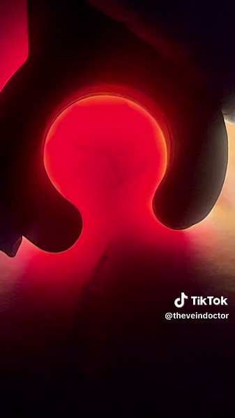 Look at me 👀 removing veins … This lamp like device is called Venoscope it lets us locate veins wirh more accuracy. Follow for more info through instagram @theveindoctor #theveindoctor #tiktokdoc #veinscheck #varicose #spiderveins