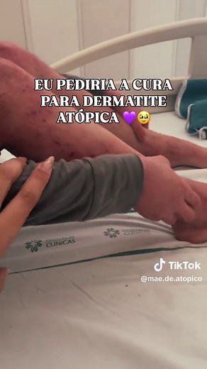 Dermatite atópica tem cura? Como controlar a doença para viver melhor