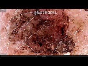 Skin cancer on scalp