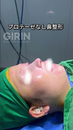 こちらは手術室で撮影された、リアルなビフォーアフター動画です📹プロテーゼを使用せず、自家組織を活用し、鼻筋軟骨移植・鼻翼軟骨移植・鼻孔下制を行い、お顔全体とのバランスを整えた症例です。