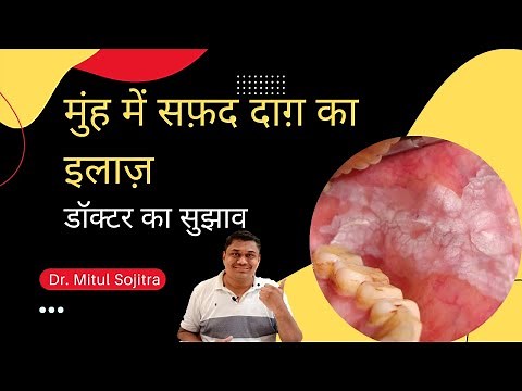 Treatment for white spots in the mouth || Treatment for white spots in the mouth || Reason for Ch...