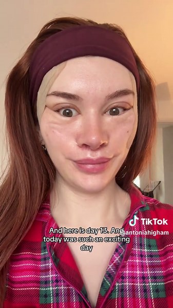 Facelift & Liplift at 28: Day 13 Recovery Vlog