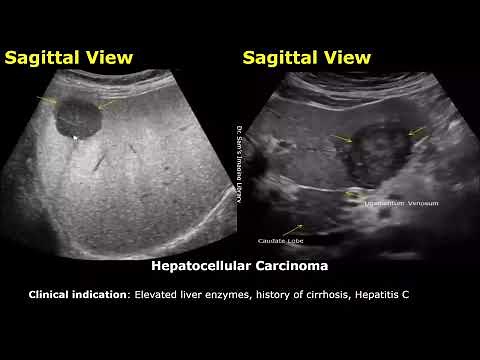 Liver Ultrasound Reporting | Liver Diseases Scan Reports | How To Write USG Report | Abdominal USG