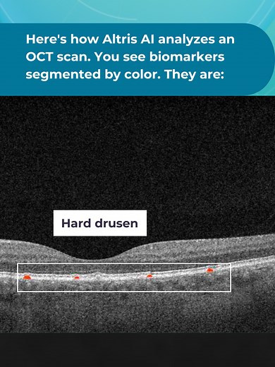 This OCT scan showcases a common pathology. Hallmarks of it are drusen. Can you identify the diagnosis based on these findings? 🤔 Explore the power of AI-powered OCT analysis with our free demo (link in bio). To experience AI for OCT on real-world scans, please register for our free demo (link in bio) #ophthalmologist #Optometrist #Optom #optometry #optometria #OCT #medicalimaging #medtech #optician #opticiansoftiktok #opticianlife #OD #MD #optometrista #ophthalmictechnicians #ophthalmology #op
