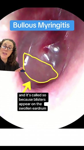 #greenscreen 🙉😢: Bullous Myringitis is a type of ear infection that is extremely painful. This is because the ear drum is loaded with nerve endings. So if the ear drum is swollen with blisters it will cause a lot of pain! ⚠️ it's usually caused by severe congestion from untreated allergies or a bad cold. 🩺👩🏻‍⚕️ Please see an ENT doctor if you think you have this. 🏆🥇 thanks to all who participated in Guess The Diagnosis! ✍️ Have an idea for the next Guess The Diagnosis! Comment below or DM