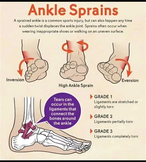🔥 ANKLE SPRAINS Explained: Types, Grades & Recovery Tips! 🔥|| #physiotherapy #physiotherapist