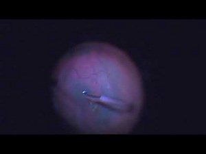 Lamellar Macular Hole Repair