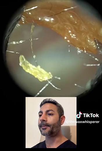 Effective Ear Wax Removal with WAXscope®