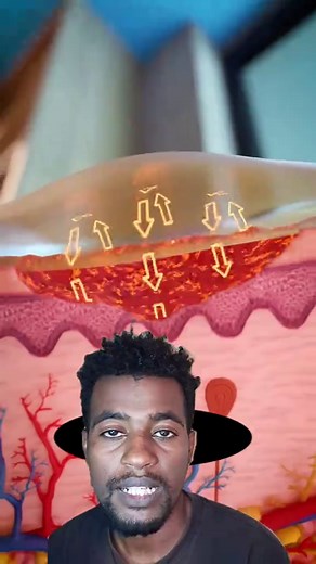 First Aid for First Degree Burns: Essential Tips