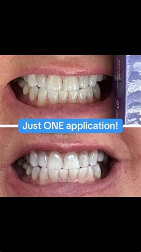 Fastest Teeth Whitening Strips You Can Buy