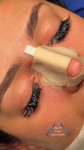 👃🏻Post-Operative Eye Care👁️💦From Poland 🇵🇱✨ | Doç.Dr. Hasan Emre KOÇAK