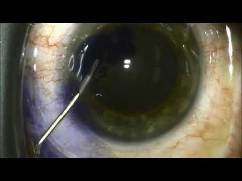Phacoemulsification: Using Vision Blue / Trypan Blue