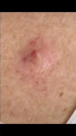 Satisfying Skin Extraction That Needed to Come Out