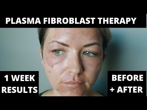 PLASMA PEN FIBROBLAST THERAPY PROCESS | 1 WEEK RESULTS BEFORE & AFTER | SKIN TIGHTENING