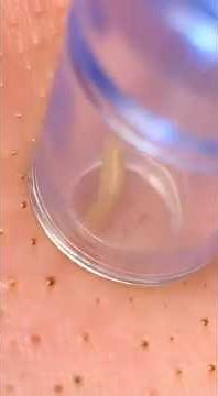 You Won't BELIEVE What Came Out! My Most Satisfying Blackhead Removal EVER