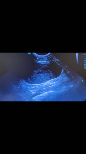 ✨ The “Twinkling Sign”: When Bladder Stones Sparkle on Ultrasound ✨ On a standard ultrasound, bladder stones usually appear as bright (hyperechoic) structures with a dark acoustic shadow behind them, a classic finding that most of us recognize instantly. But when the image isn’t clear or the stones are tiny, turning on color Doppler can reveal something special: the twinkling sign. 💫 🔹 What it looks like: A rapidly alternating red and blue color signal behind the stone: mimicking turbulent flo