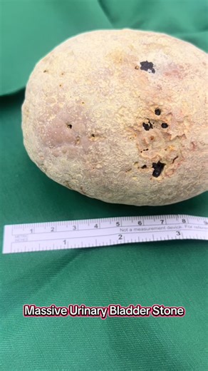 Once in a while, a stone this big comes along. Performed an open cystolithotomy for a massive 10cm bladder stone — a rare case that reminds us some conditions still require traditional surgery. Don’t wait for symptoms to get worse. Regular check-ups and early intervention can prevent complications like this. #urology #bladderstones #cystolithotomy #menshealth #urologistlife #healthawareness #preventivecare #urology360 #varelaurologica #manilakidneyandprostatecareclinic #fyp #fypppppppppppppppppp