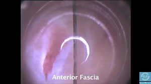 Visiport laparoscopic entry layer by layer. Optical Trocar described Layer by Layer, instruction for training A.L. Thurkow MD Ob/Gyn | SurgMedia