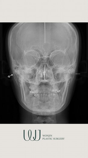2.2K views | CT scan view of facial contouring (cheekbone, chin, jaw...