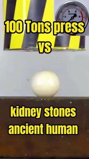 100 Tons Press vs Kidney Stones: Crushing Experiment
