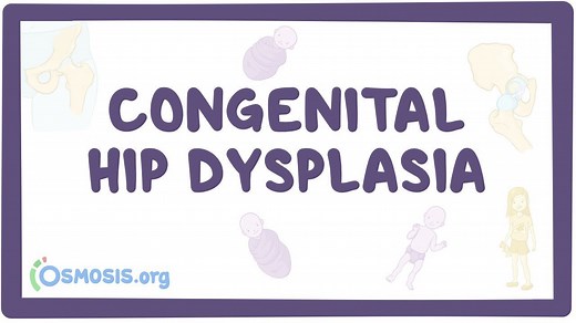 Developmental dysplasia of the hip: Video, Causes, & Meaning | Osmosis