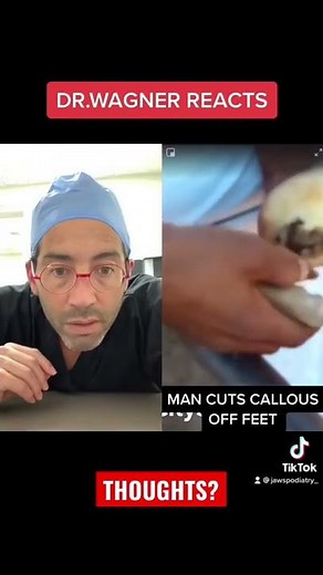 OMG CALLUS “SHAVING” 🤯#shorts #callus #callusremoval