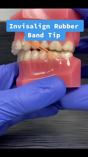 Invisalign Rubber Bands. These are used to fix bites, mainly an “overbite.” The tip in this video has worked for the few patients of mine who have had the aligner hook poke their cheek. #orthodontist #orthodontics #invisalign #clearaligners #orthodontistsoftiktok #bracesrubberbands