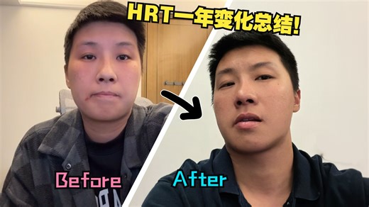 FTM｜V12.HRT一年期变化总结—— 跨男的激素前后对比