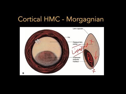 Lens - Part 2: Cataract - Pathophysiology & Types
