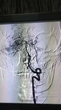 IV vessel DSA (Digital substraction Angiography)# Radiology #neurology#cathlab#brain#headchach