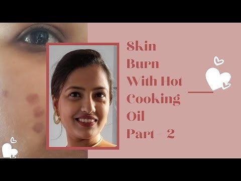 BURN TREATMENT - HOW TO Remove Your Burn Marks from Skin #2| Step By Step QnA ‪@funkiecouple‬