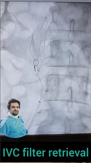 IVC filter retrieval