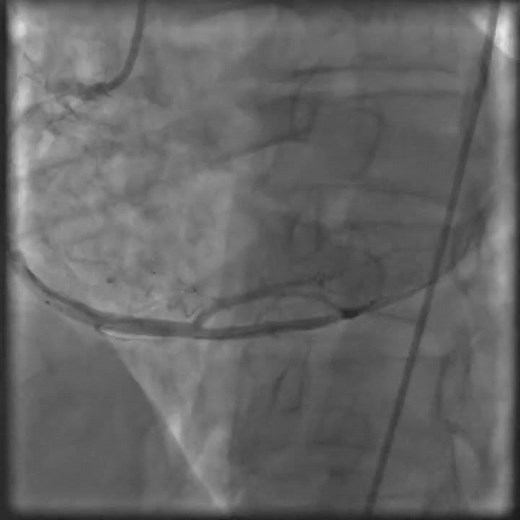 Acute myocardial infarction