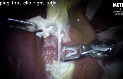 Robot performs gallbladder surgery without any human help