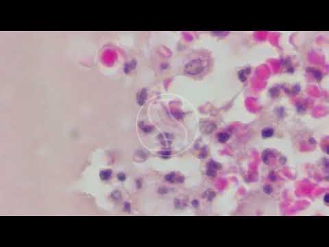 Granuloma Inguinale with Haematoxylin and Eosin (H&E) Stain
