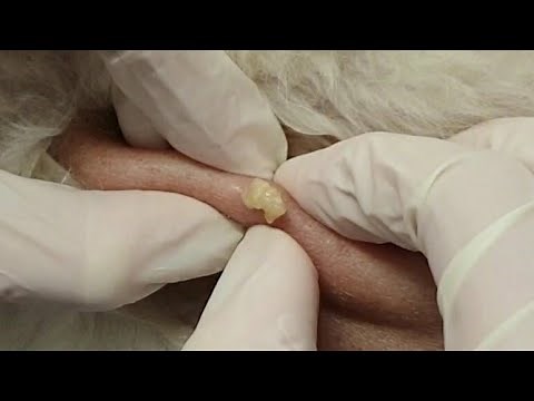 SEBACEOUS CYST/ PIMPLE SQUEEZE on a dog