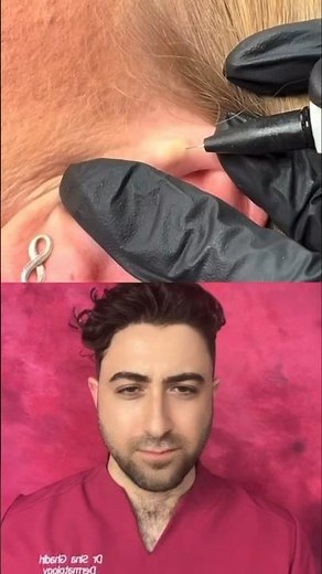 Cyst extraction on the ear