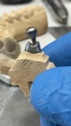 Creating Zircon Crown with CAD/CAM Technology