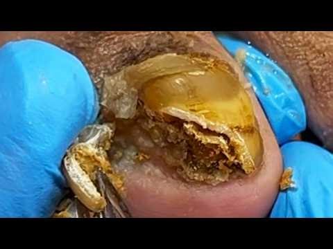 Clean Black Dirt & Treat Nail Fungus【Podiatry Clinic】