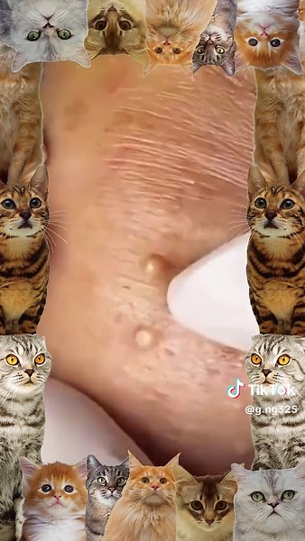 Blackhead and Cyst Removal Techniques