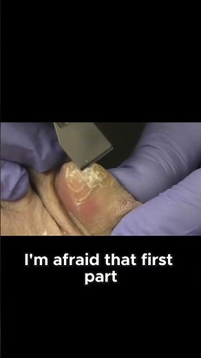 Understanding Nail Health Causes of Yellow Toenails #NailCare #HealthTips #YellowNails