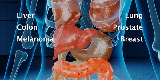 Medical Moment: Blasting away tumors with lattice therapy