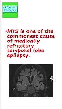 Mesial Temporal Sclerosis in 2 minutes
