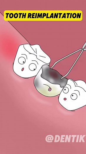 Real Tooth Replacement! How Natural Teeth Can Be Replanted to Fix a Missing Tooth #healthtips #dentist #dental