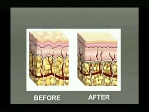 Fat reduction with Injection Lipolysis / Lipodissolve