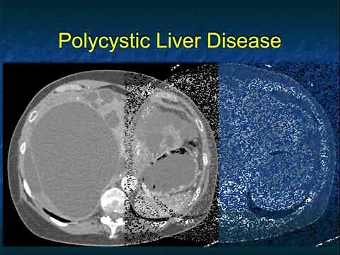 CT Evaluation of Liver Masses: Key Differential Diagnosis Findings - Part 1